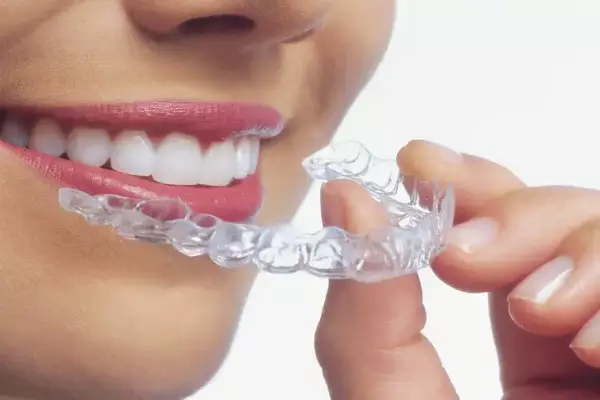 פלטות שקופות ליישור שיניים