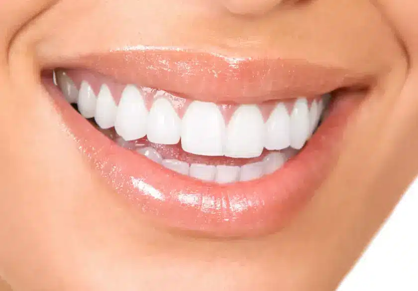 הלבנת שיניים